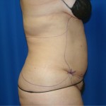 Liposuction Before & After Patient #864