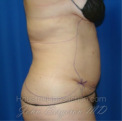 Liposuction Before & After Patient #864