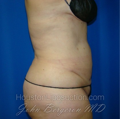 Liposuction Before & After Patient #864