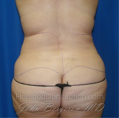 Liposuction Before & After Patient #864