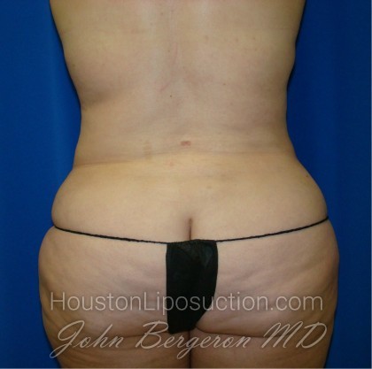 Liposuction Before & After Patient #864