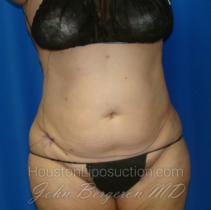 Liposuction Before & After Patient #864