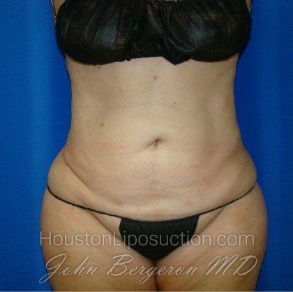 Liposuction Before & After Patient #864