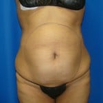 Liposuction Before & After Patient #871