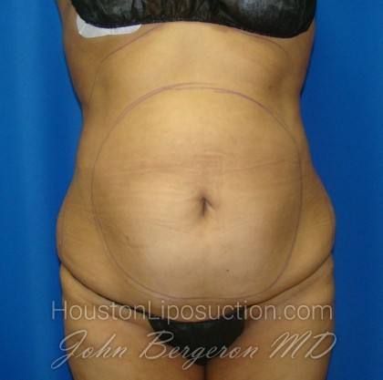 Liposuction Before & After Patient #871