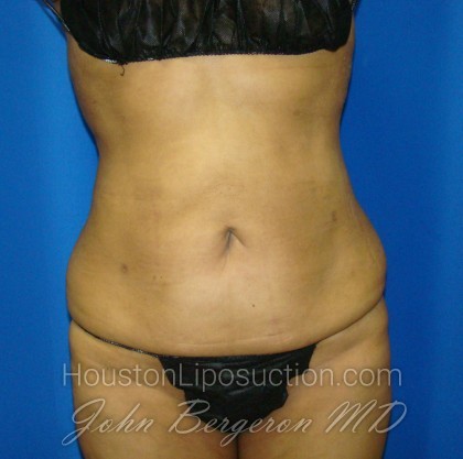 Liposuction Before & After Patient #871