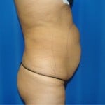 Liposuction Before & After Patient #871