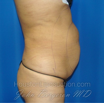 Liposuction Before & After Patient #871