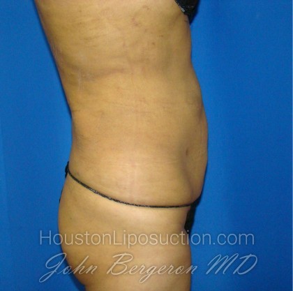 Liposuction Before & After Patient #871