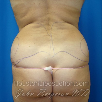 Liposuction Before & After Patient #884
