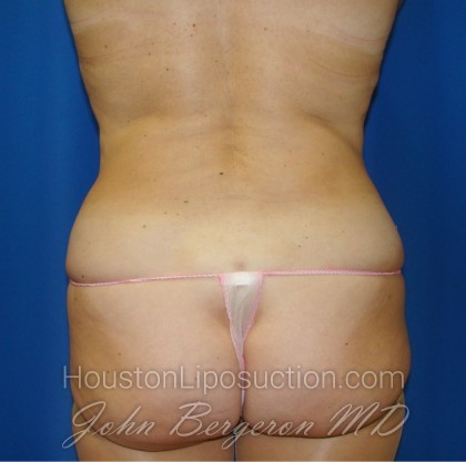 Liposuction Before & After Patient #884