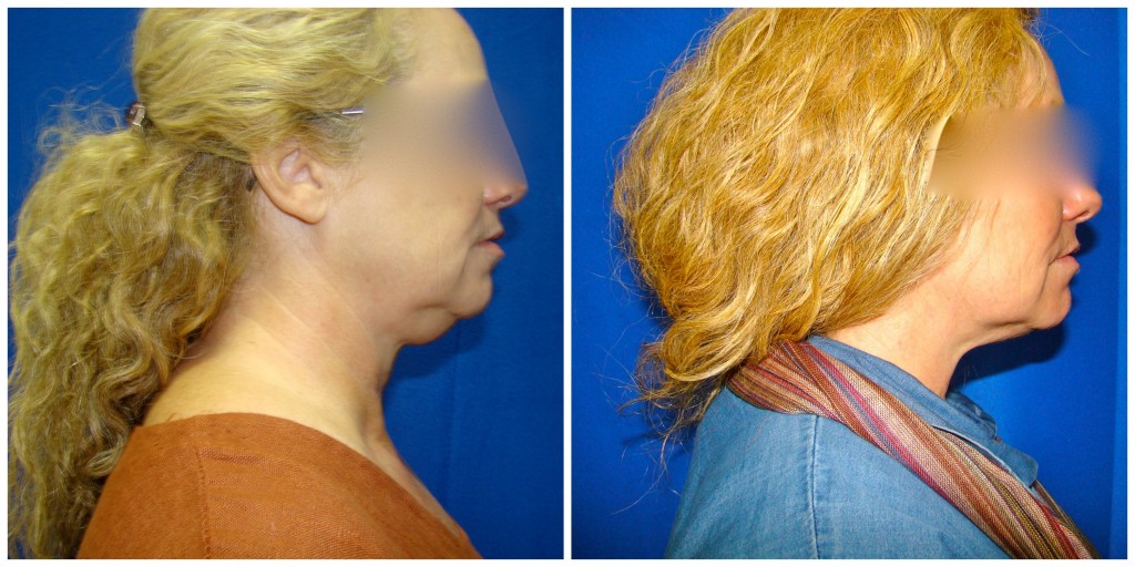 Chin Liposuction Before and After