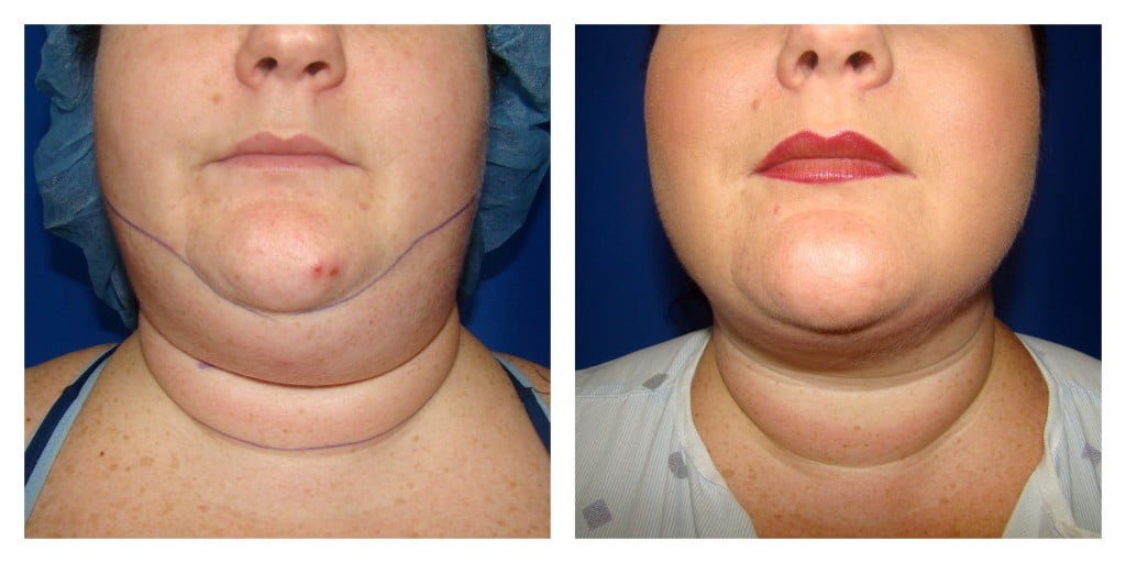 Houston Chin Liposuction Patient