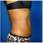 Liposuction Before & After Patient #936