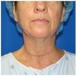 Liposuction Before & After Patient #941