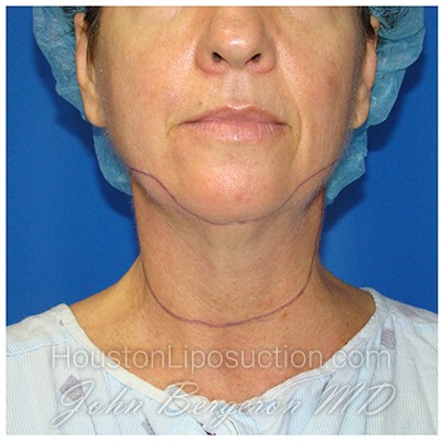 Liposuction Before & After Patient #941