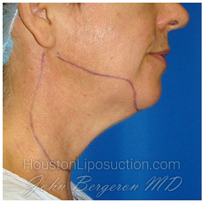 Liposuction Before & After Patient #941