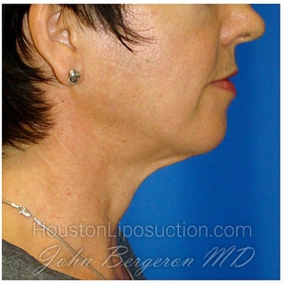 Liposuction Before & After Patient #941
