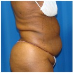 Liposuction Before & After Patient #946