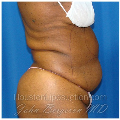 Liposuction Before & After Patient #946