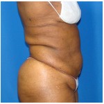 Liposuction Before & After Patient #946