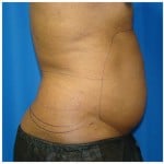 Liposuction Before & After Patient #962