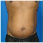 Liposuction Before & After Patient #962