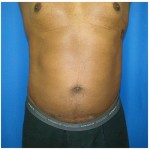 Liposuction Before & After Patient #962