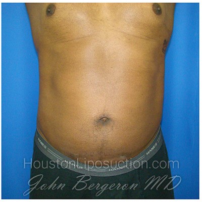 Liposuction Before & After Patient #962