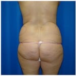 Liposuction Before & After Patient #983