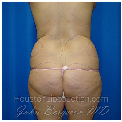 Liposuction Before & After Patient #983