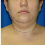 Liposuction Before & After Patient #967
