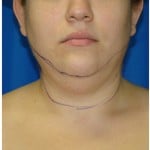 Liposuction Before & After Patient #967