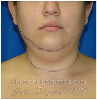 Liposuction Before & After Patient #967