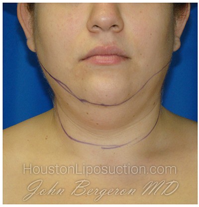 Liposuction Before & After Patient #967