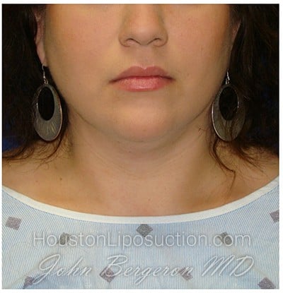 Liposuction Before & After Patient #967