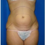 Liposuction Before & After Patient #978