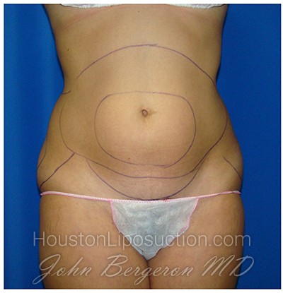 Liposuction Before & After Patient #978