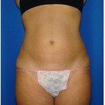 Liposuction Before & After Patient #978