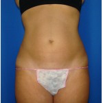 Liposuction Before & After Patient #978