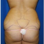 Liposuction Before & After Patient #978