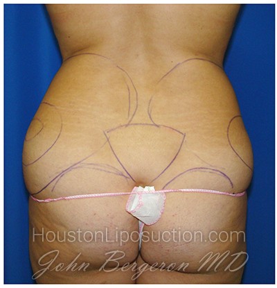 Liposuction Before & After Patient #978