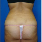 Liposuction Before & After Patient #978