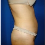 Liposuction Before & After Patient #975