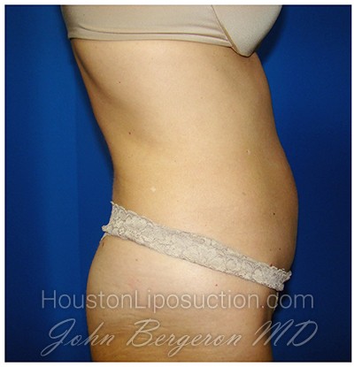 Liposuction Before & After Patient #975