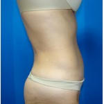 Liposuction Before & After Patient #975
