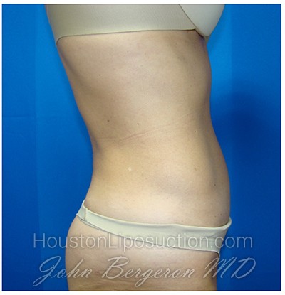 Liposuction Before & After Patient #975