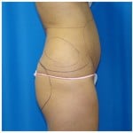 Liposuction Before & After Patient #970