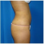 Liposuction Before & After Patient #970