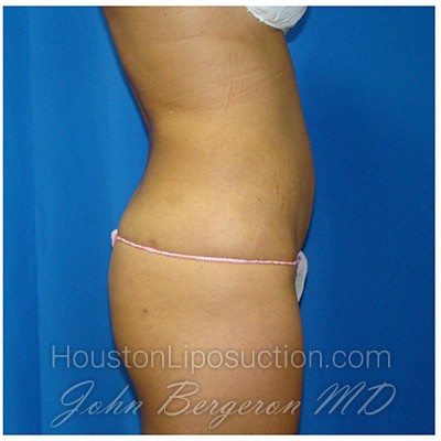 Liposuction Before & After Patient #970